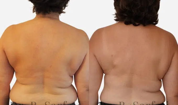 Poitrine de femme avant et apres une reconstruction mammaire par injection de graisse Dr Benjamin Sarfati paris