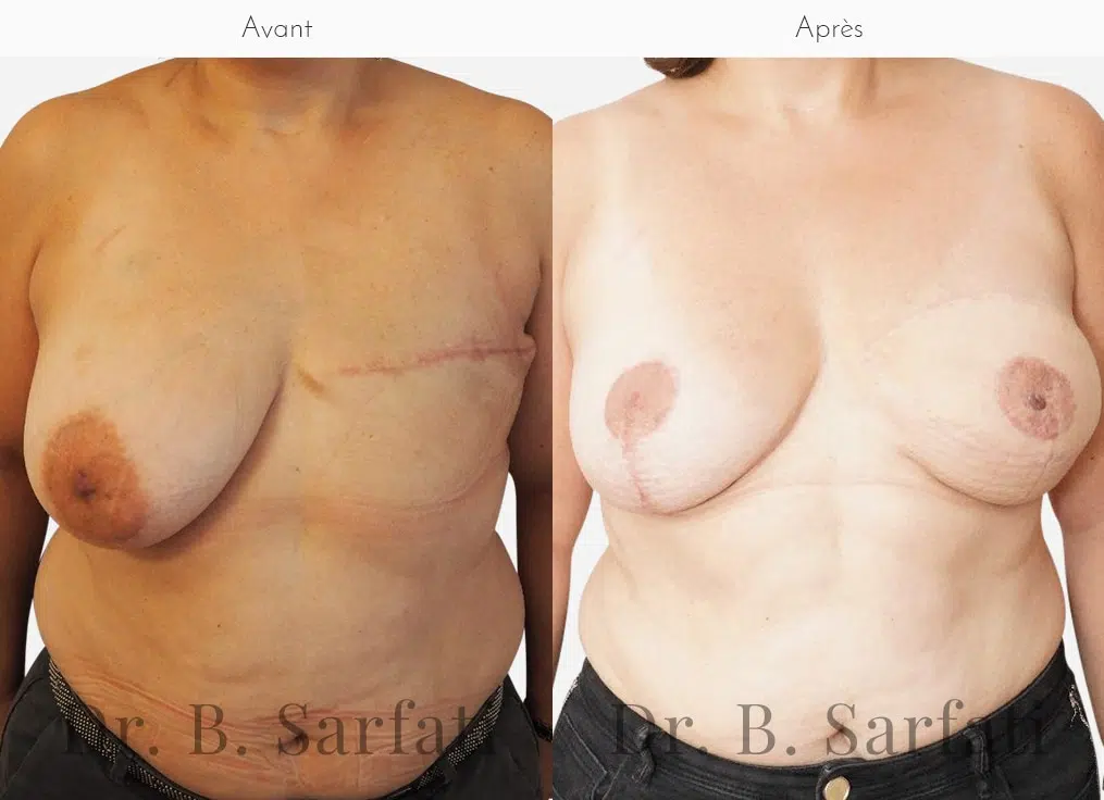 Poitrine avant et apres une reconstruction mammaire par injection de graisse Dr Benjamin Sarfati paris