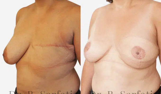 Poitrine de femme avant et apres reconstruction mammaire par lambeau de grand dorsal Dr Benjamin Sarfati paris