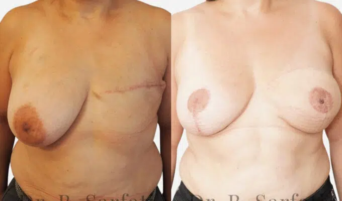 Poitrine avant et apres reconstruction mammaire par lambeau de grand dorsal Dr Benjamin Sarfati paris