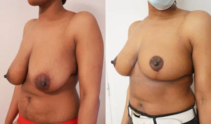 Poitrine de femme avant et apres reduction mammaire bilateral Dr benjmin Sarfati Paris