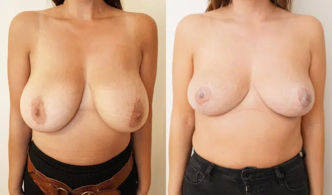 Poitrine de femme avant et apres reduction mammaire bilateral urgotouch Dr benjmin Sarfati Paris