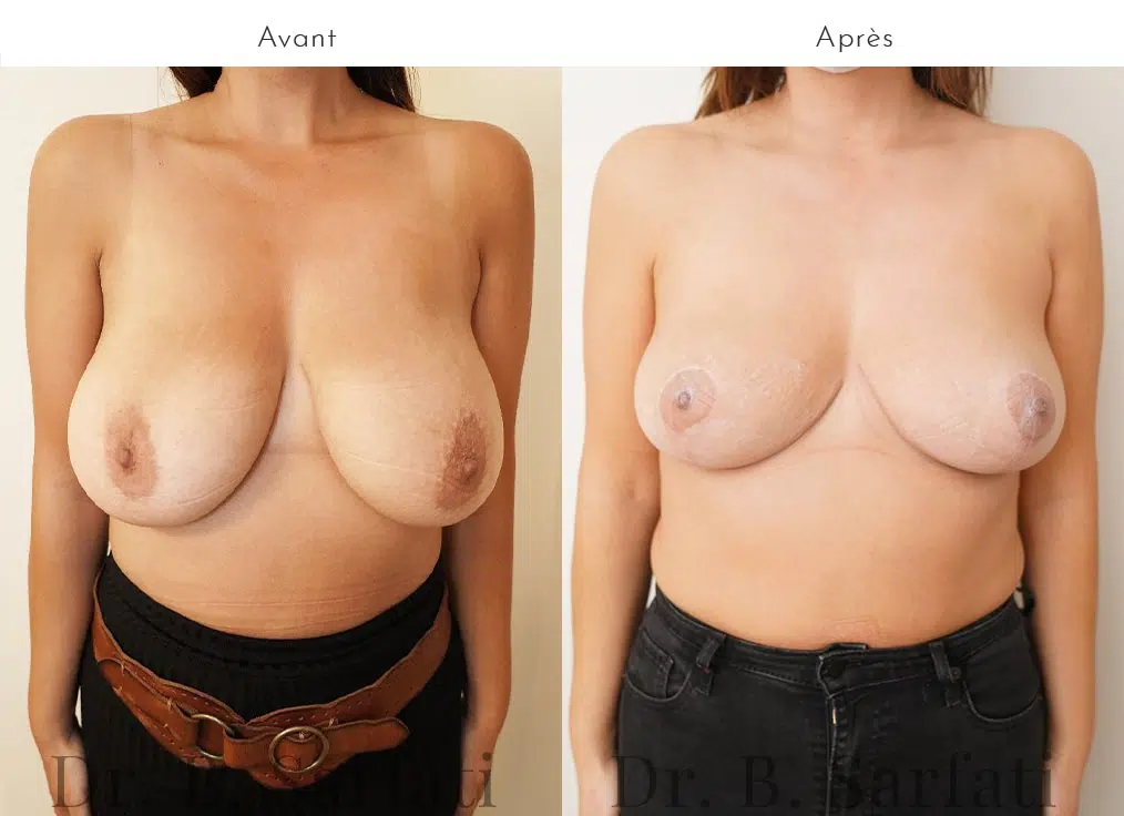 Poitrine de femme avant et apres reduction mammaire bilateral urgotouch Dr benjmin Sarfati Paris