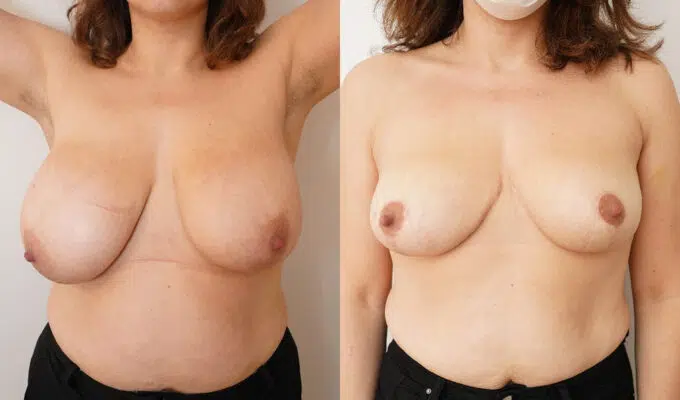 Poitrine avant et apres reduction mammaire bilateral urgotouch Dr benjmin Sarfati Paris