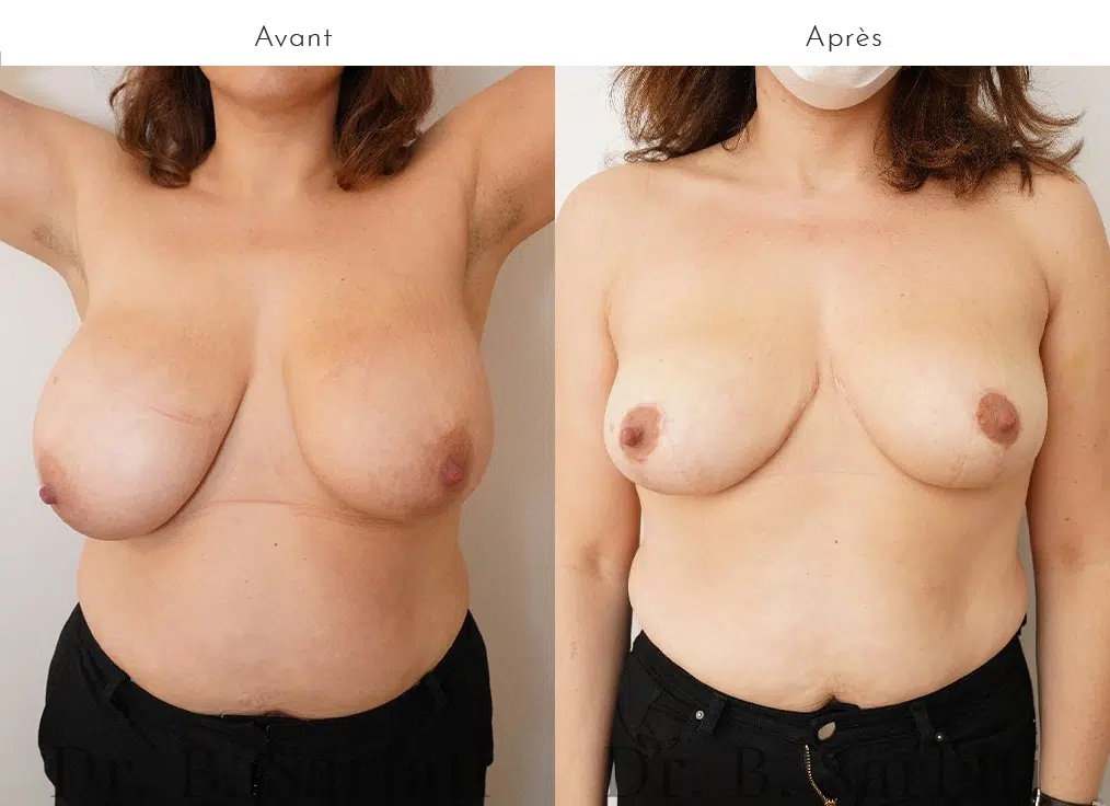 Poitrine avant et apres reduction mammaire bilateral urgotouch Dr benjmin Sarfati Paris