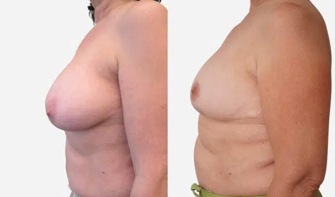 Poitrine avant et apres reduction mammaire bilateral Dr benjmin Sarfati Paris