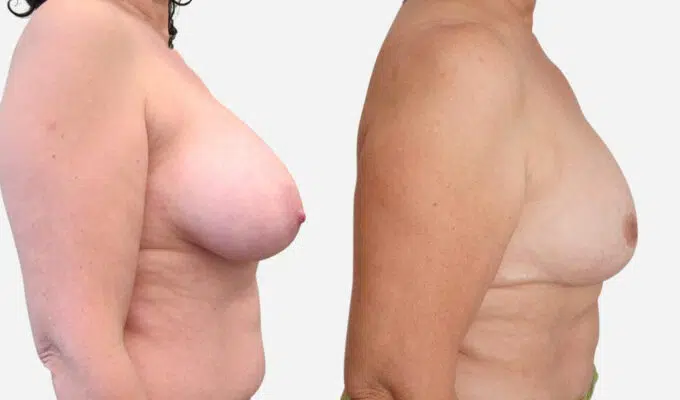 Poitrine de femme avant et apres reduction mammaire bilateral Dr benjmin Sarfati Paris