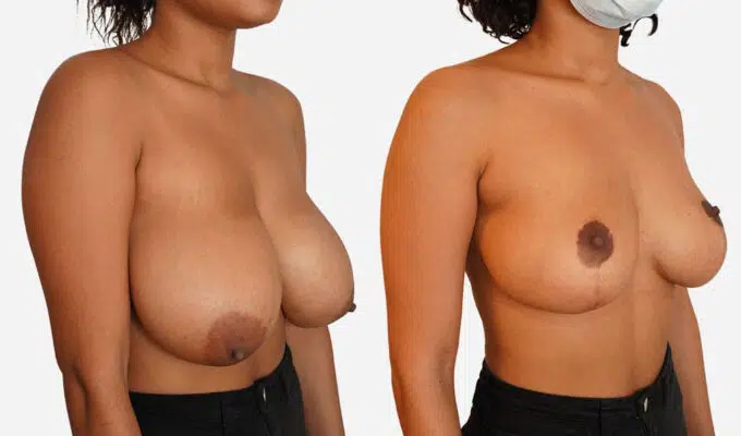 Poitrine avant et apres reduction mammaire bilaterale avec cictatrice en t inverse Dr Benjamin Sarfati paris