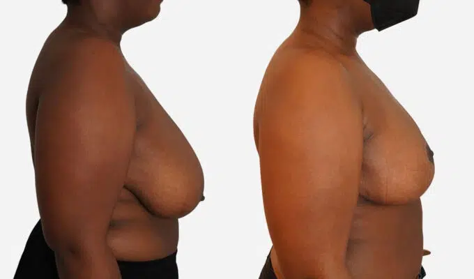 Poitrine de femme avant et apres reduction mammaire bilaterale avec cictatrice en t inverse Dr Benjamin Sarfati paris