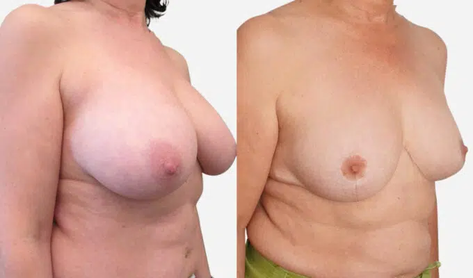 Poitrine avant et apres reduction mammaire bilaterale Dr Benjamin Sarfati paris