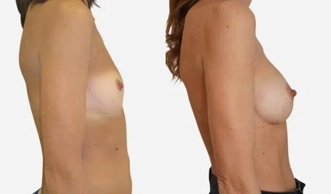 Poitrine de femme avant et apres augmentation mammaire par prothese Dr BEnjamin Sarfati Paris