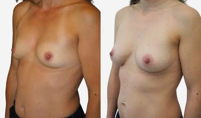 Poitrine de femme avant et apres augmentation mammaire par prothese Dr BEnjamin Sarfati Paris