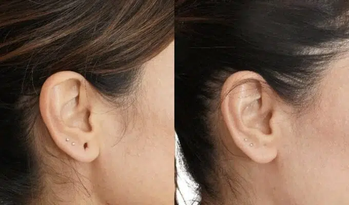 Oreille de femme avant et apres Fermeture lobe fendu chirurgie de l oreil Dr Benjamin Sarfati paris