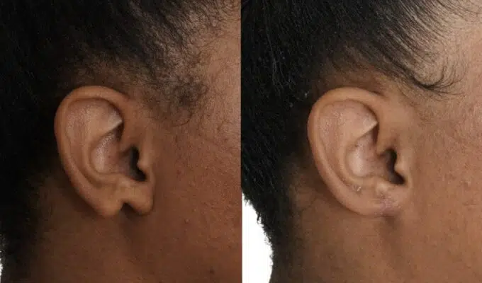 Oreille de femme apres et avant et correction de malformation de l oreille gauche Dr Benjamin Sarfati paris