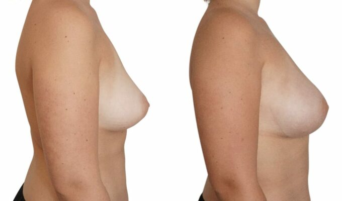 Poitrine avant et apres une augmentation mammaire par injection de graisse Lipofilling Dr Benjamin Sarfati paris
