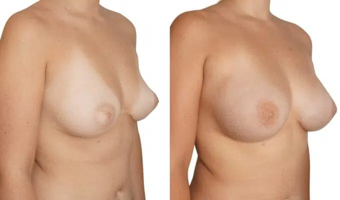 Poitrine de femme avant et apres une augmentation mammaire par injection de graisse Lipofilling Dr Benjamin Sarfati paris