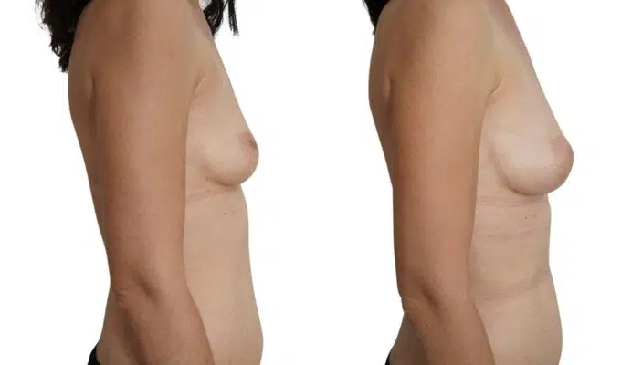Poitrine de femme avant et apres une augmentation mammaire par injection de graisse Lipofilling Dr Benjamin Sarfati paris
