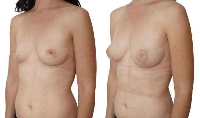 Augmentation mammaire par injection de graisse | Dr Benjamin Sarfati | Paris