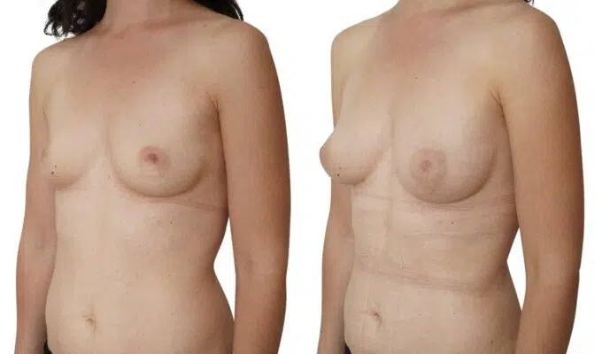 Poitrine avant et apres une augmentation mammaire par injection de graisse Lipofilling Dr Benjamin Sarfati paris
