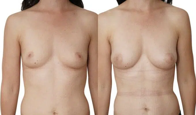 Poitrine de femme avant et apres une augmentation mammaire par injection de graisse Lipofilling Dr Benjamin Sarfati paris