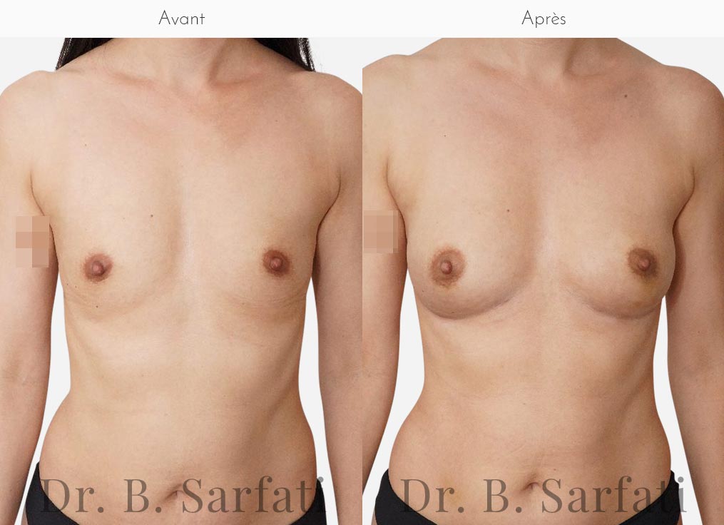 Poitrine de femme avant et apres une augmentation mammaire par injection de graisse Lipofilling Dr Benjamin Sarfati paris