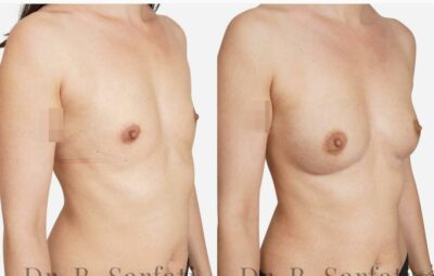Poitrine avant et apres une augmentation mammaire par injection de graisse Lipofilling Dr Benjamin Sarfati paris