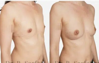 Poitrine avant et apres une augmentation mammaire par injection de graisse Lipofilling Dr Benjamin Sarfati paris