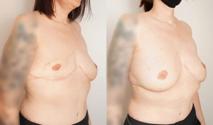 Poitrine de femme avant et apres Lipofilling du sein droit Dr Benjamin Setrfati paris