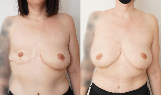 Poitrine avant et apres lipofiling sein droit avec reconstruction mammaire Dr Benjamin Sarfati paris