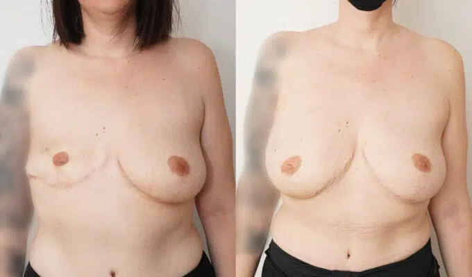 Poitrine  de face avant et apres Lipofilling du sein droit Dr Benjamin Setrfati paris