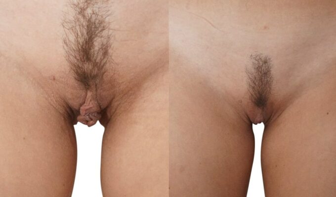 Partie intime de femme avant et apres chirurgie esthetique pour l intime Dr Benjamin Sarfati paris
