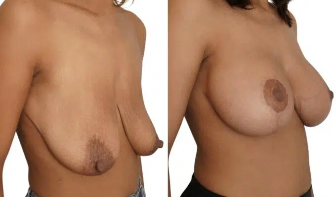 Poitrine de femme avant et apres cure de ptose mammaire et lifiting mammaire Dr Benjamin Sarfati paris