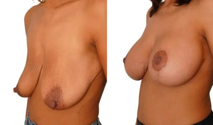 Poitrine avant et apres cure de ptose mammaire et lifiting mammaire Dr Benjamin Sarfati paris