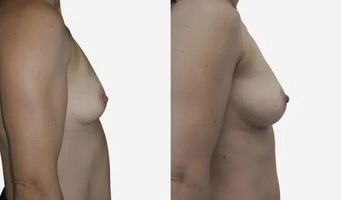 Poitrine de femme avant et apres une augmentation mammaire par prothese Dr Benjamin Sarfati paris