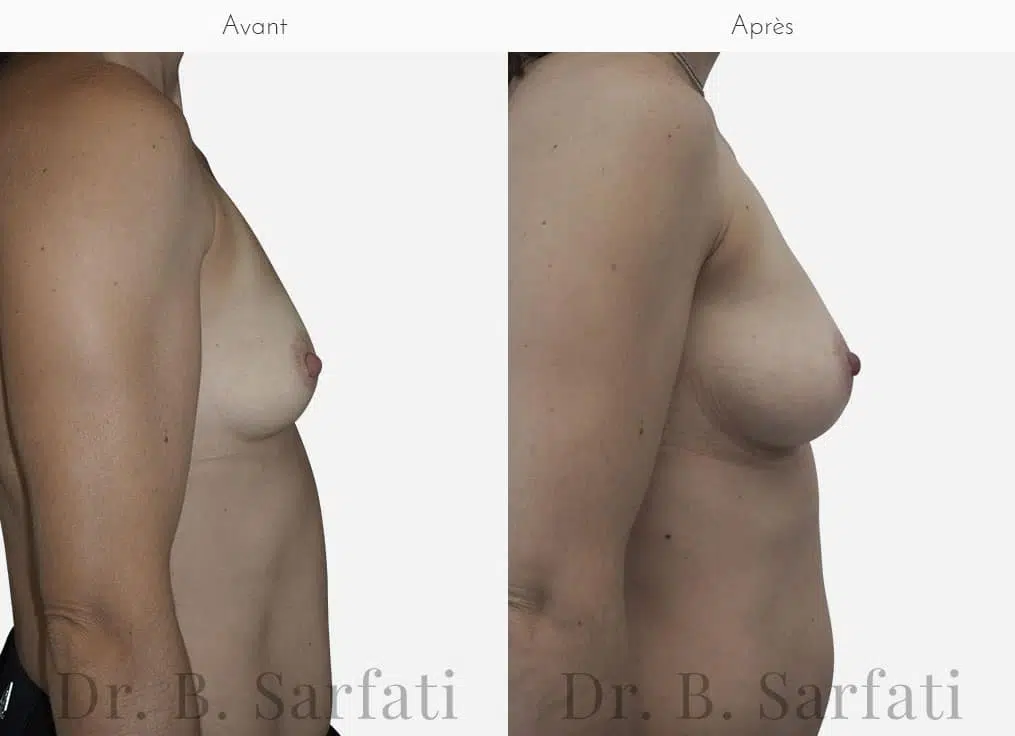 Poitrine de femme avant et apres une augmentation mammaire par prothese Dr Benjamin Sarfati paris