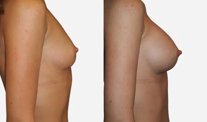 Poitrine avant et apres une augmentation mammaire par prothese ronde Dr Benjamin Sarfati paris