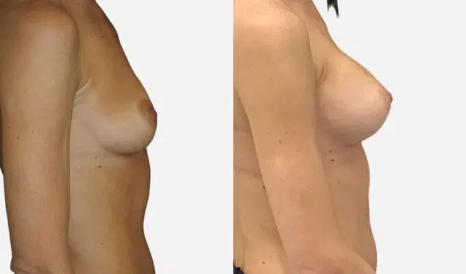 Poitrine de femme avant et apres une augmentation mammaire par prothese Dr Benjamin Sarfati paris