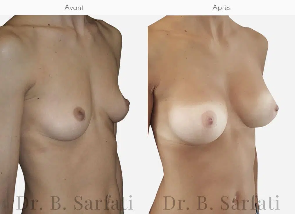 Poitrine avant et apres une augmentation mammaire par prothese Dr Benjamin Sarfati paris