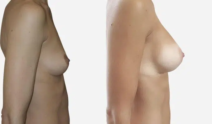 Poitrine de femme avant et apres une augmentation mammaire par prothese Dr Benjamin Sarfati paris