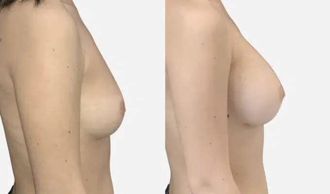 Poitrine avant et apres une augmentation mammaire par prothese ronde Dr Benjamin Sarfati paris
