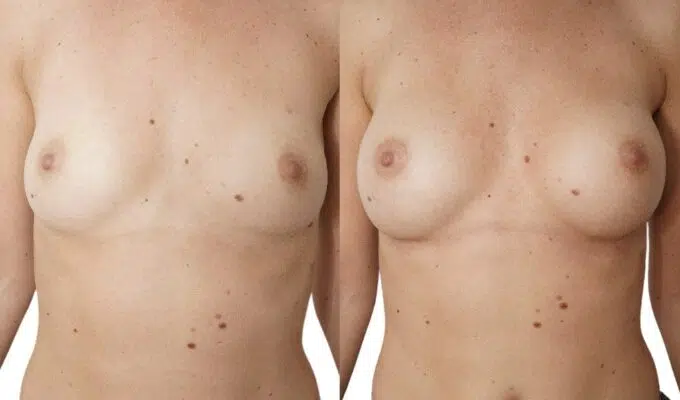 Poitrine de femme avant et apres une augmentation mammaire par prothese ronde Dr Benjamin Sarfati paris