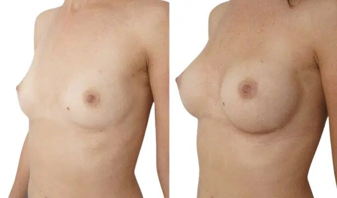 Poitrine avant et apres une augmentation mammaire par prothese Dr Benjamin Sarfati paris