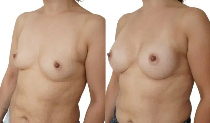 Poitrine avant et apres une augmentation mammaire par prothese  Dr Benjamin Sarfati paris