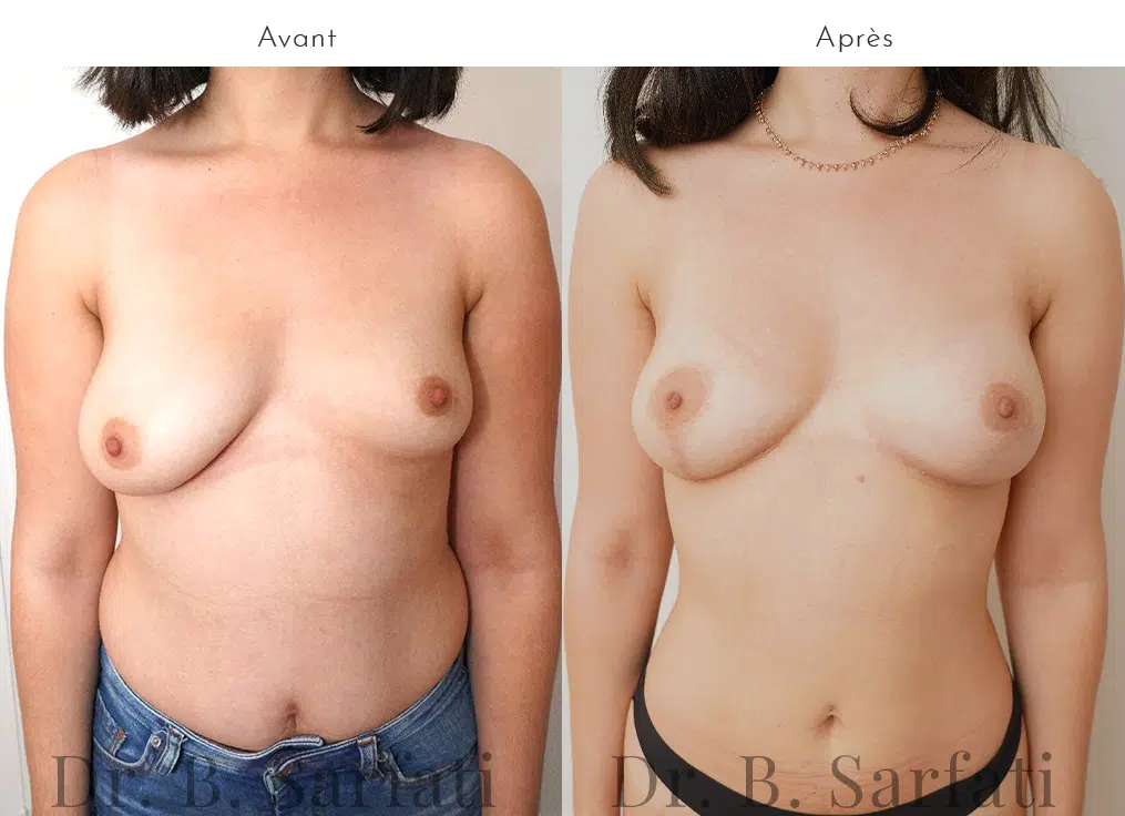Poitrine de femme avant et apres lipofilling mammaire pour corriger une asymetrie mammaire Dr Benjamin Sarfati paris