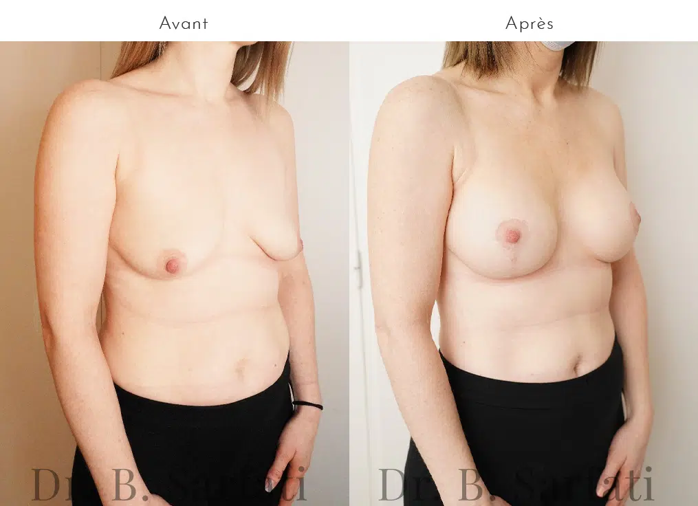Poitrine  de femme avant et apres cure de ptose mammaire et lifiting mammaire plastie mammaire urgotouch  Dr Benjamin Sarfati paris
