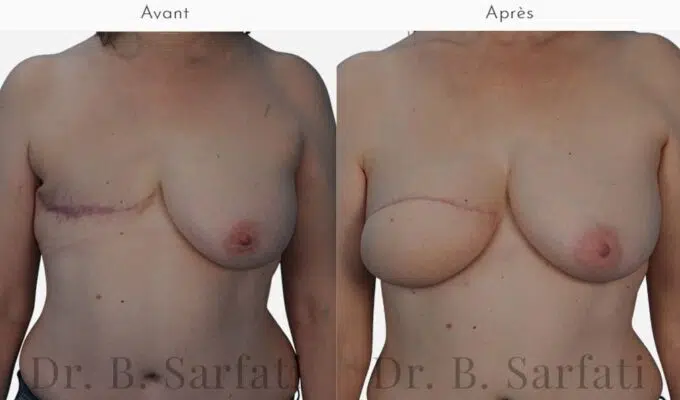 Poitrine avant et apres reconstruction mammaire par lambeau de DIEP Dr Benjamin Sarfati paris