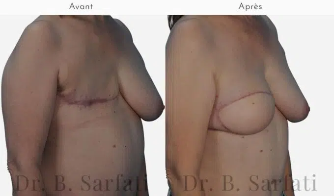 Poitrine de femme avant et apres reconstruction mammaire par lambeau de DIEP Dr Benjamin Sarfati paris