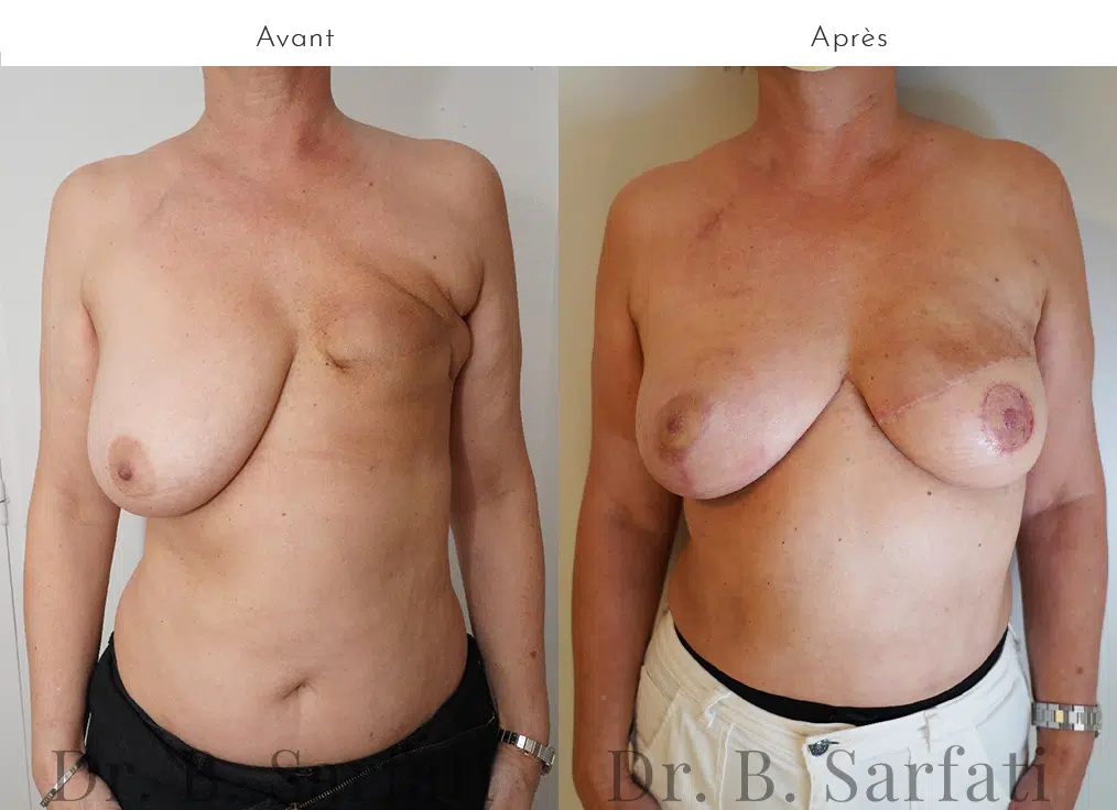 Poitrine avant et apres reconstruction mammaire par lambeau grand dorsal Dr Benjmain Sarfati paris