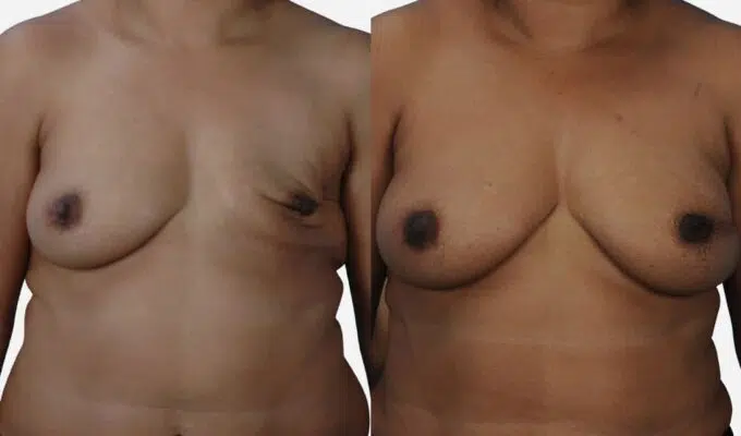 Poitrine de femme avant et apres une reconstruction mammaire total du sein gauche par injection de graisse Dr Benjamin Sarfati paris