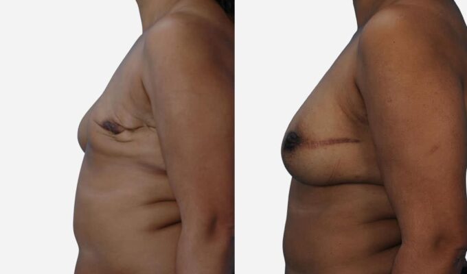 Poitrine de femme de profile gauche avant et apres reconstruction mammaire totale du sein gauche par injection de graisse lipofilling Dr Benjamin Sarfati paris